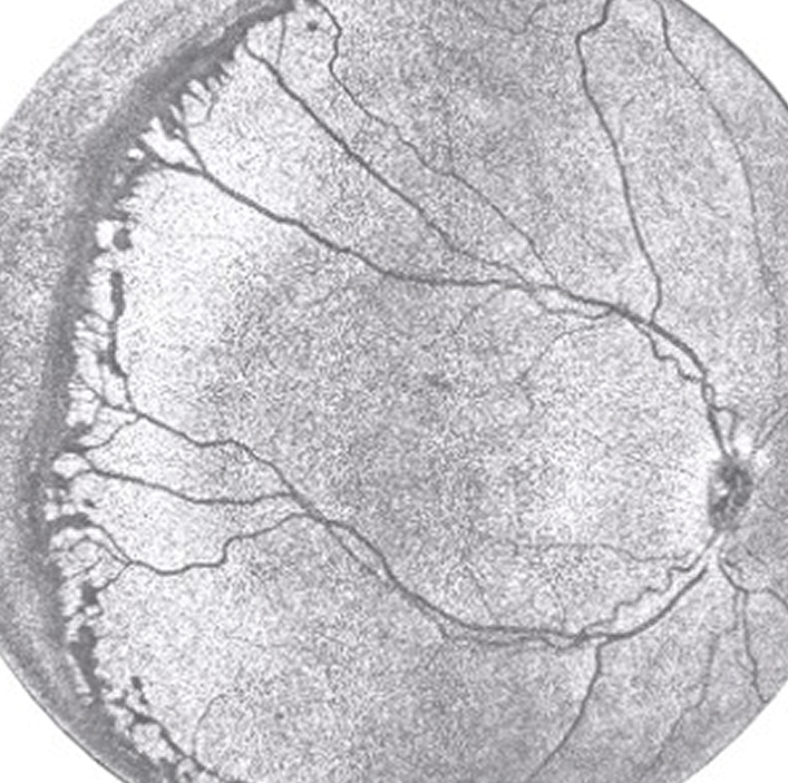 Casey Eye Institute OCT