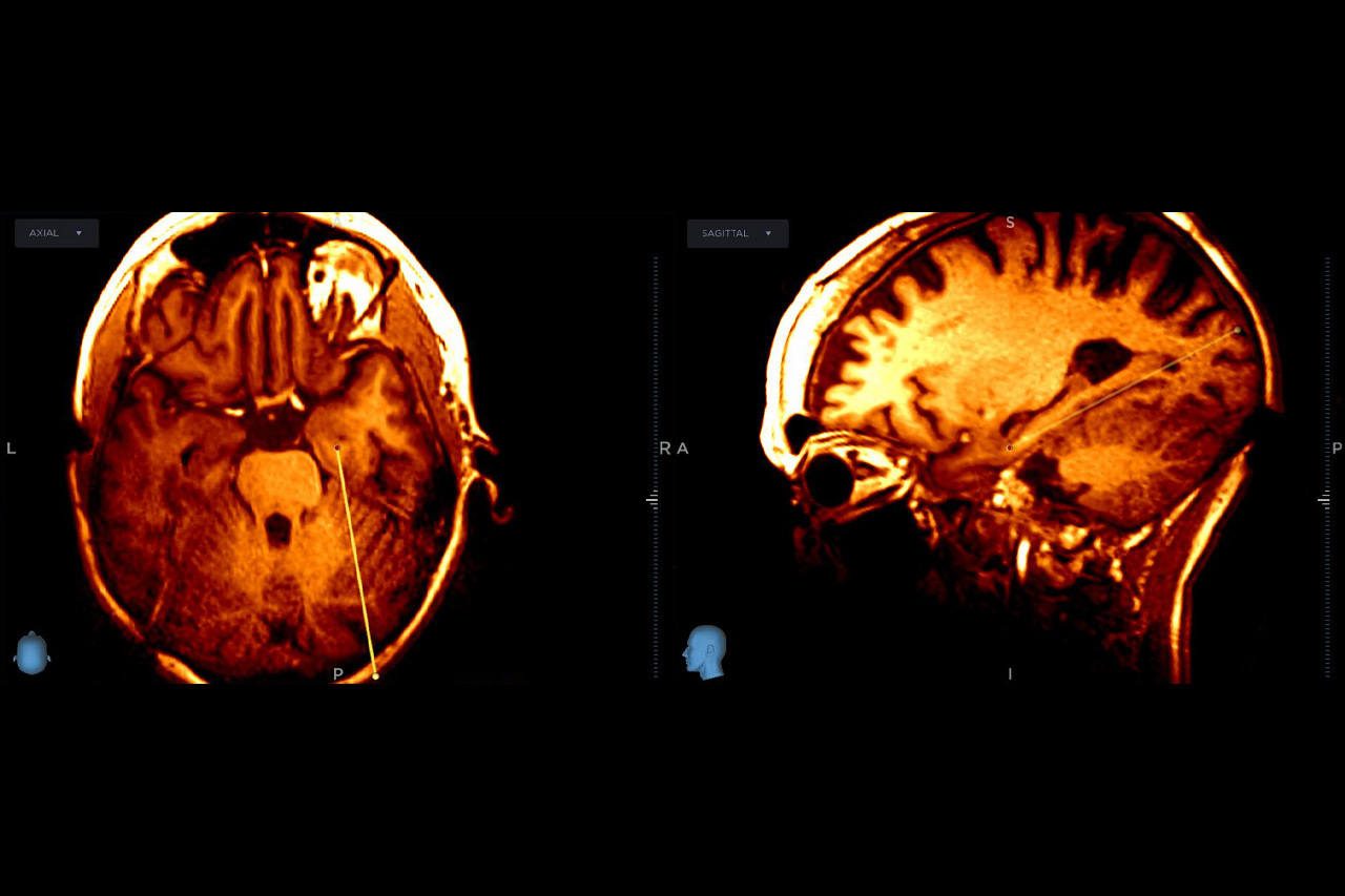 Frontiers In Epilepsy Treatment And Research